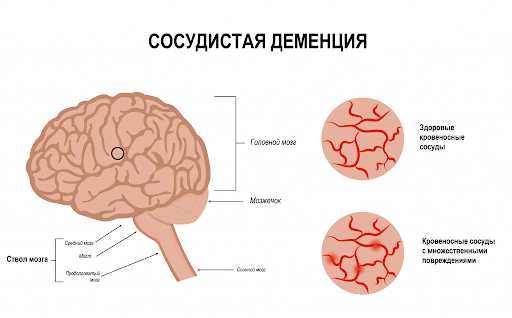 сосудистая деменция